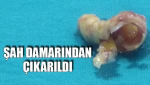 ŞAH DAMARINDAN ÇIKARILDI
