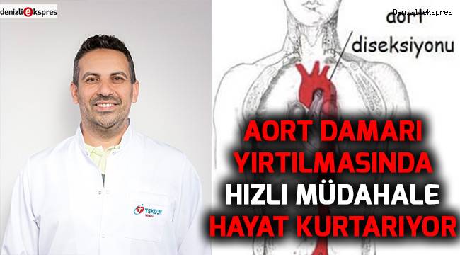 Aort damarı yırtılmasında hızlı müdahale hayat kurtarıyor