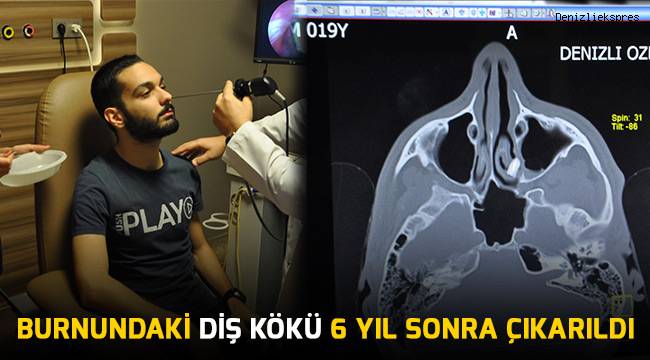 Burnundaki diş kökü 6 yıl sonra çıkarıldı
