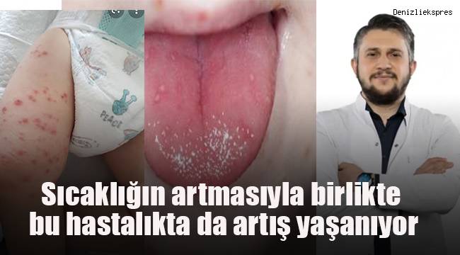 Sıcaklığın artmasıyla birlikte bu hastalıkta da artış yaşanıyor