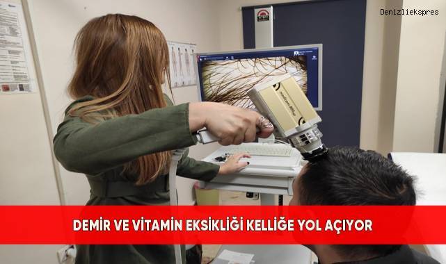 Demir ve Vitamin Eksikliği Kelliğe Yol Açıyor