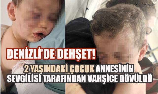 Denizli'de 2 yaşındaki çocuk annesinin sevgilisi tarafından vahşice dövüldü